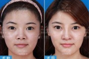 重塑你的面部中轴线：详解当代最先进的鼻整形技术，告别“网红假鼻”时代